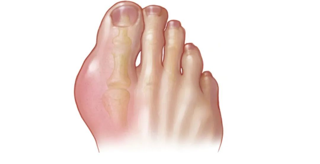 误把痛风当成关节炎，我以为自己要瘸掉